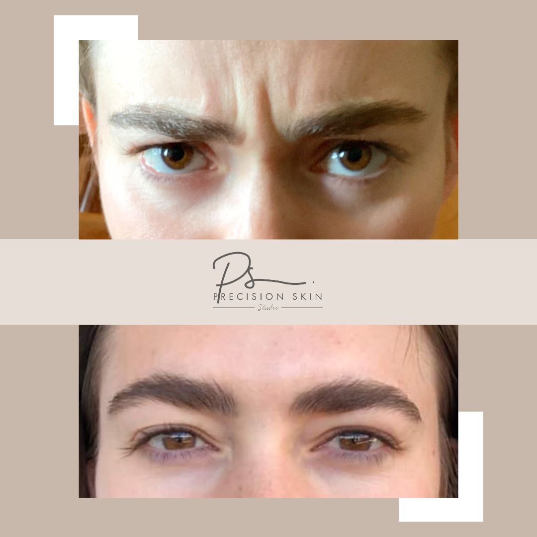 Two-panel photo of the forehead and brow area shared by the studio