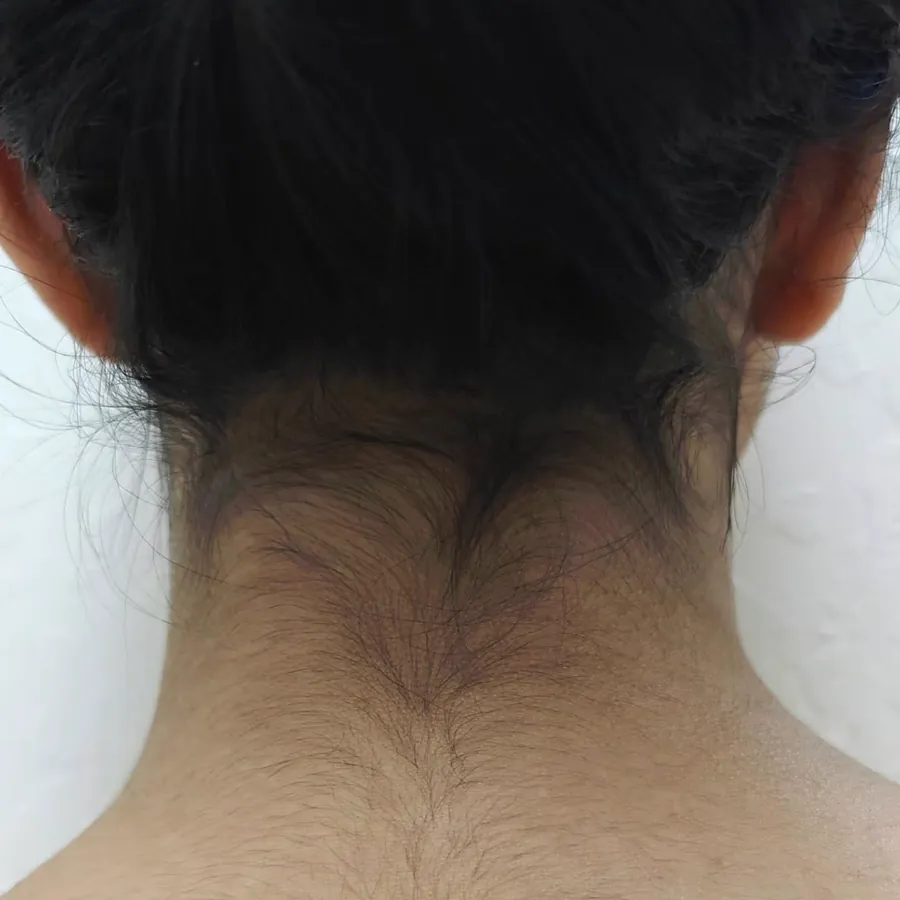 The back of a client's neck with fine hair along the hairline, before treatment